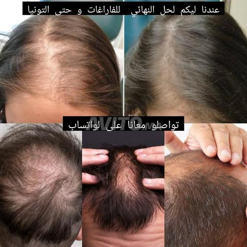 زيت المعجزة للتساقط لحاد و الفراغات و الثعلبة