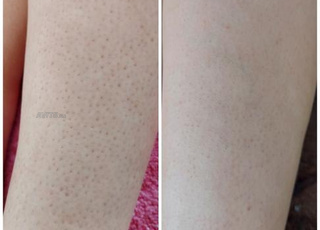 lumière pulsée IPL/SHR