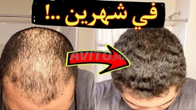 أعشاب طبيعية ديال الصحراء لزيادة شعر من الأمام